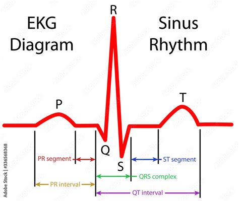 Image result for Sinus Rhythm Diagram
