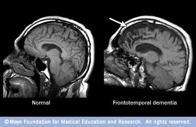 Afbeeldingsresultaten voor Frontal Cortex MRI Normal Side View