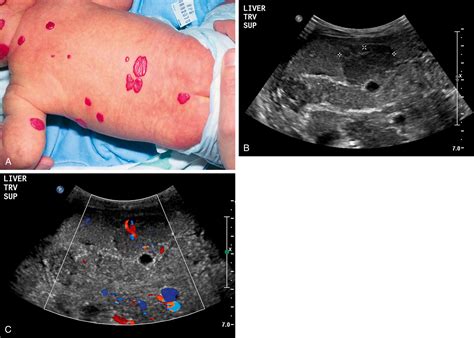 Toradh íomhá ar Sizes of Cutaneous Defect
