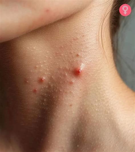 Image result for Pimples On Back of Neck