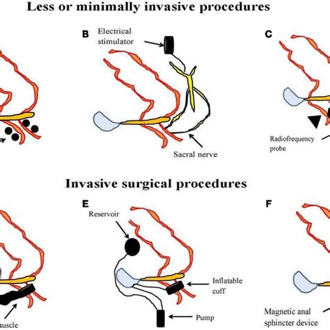 High Resolution Colonic Manometry Drawing に対する画像結果