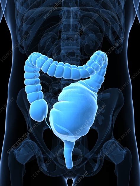 Image result for Toxic Megacolon Next to Normal