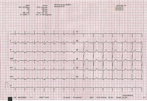 Afbeeldingsresultaten voor Normal ECG Trace