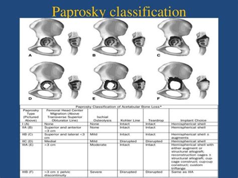 Afbeeldingsresultaten voor AAOS Acetabular Defect Classification