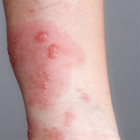 Rhus Dermatitis Face-এর ছবি ফলাফল