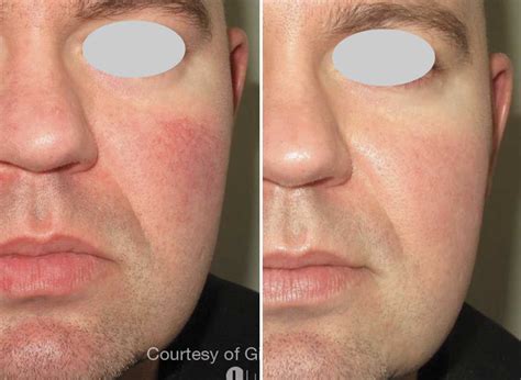 Image result for Rosacea