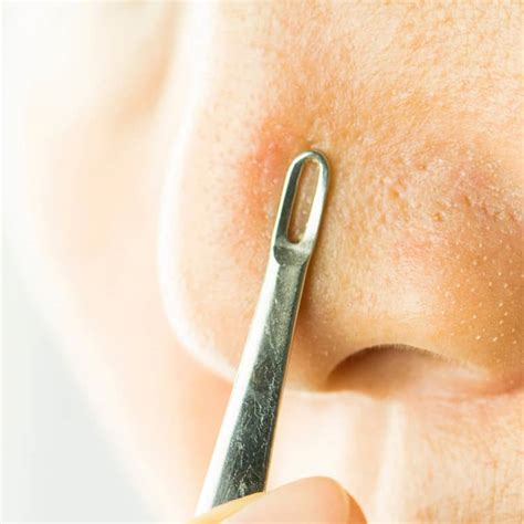 Exploding Comedones に対する画像結果