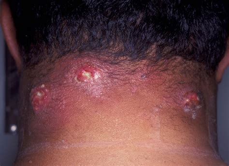 Carbuncle - Pictures, Symptoms, Causes, Treatment and Removal