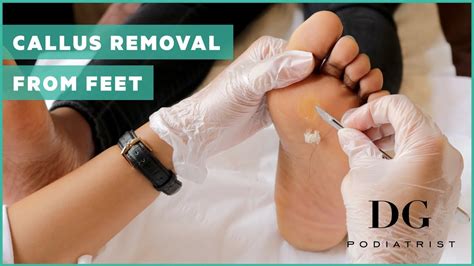 Image result for Best Way to Remove Foot Callus