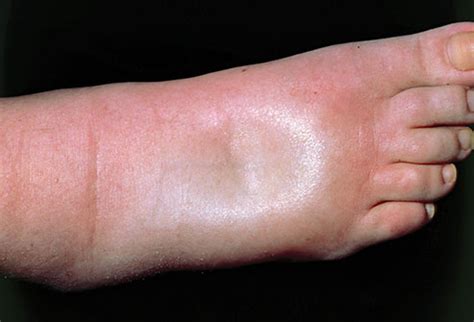 Image result for Edema Cure