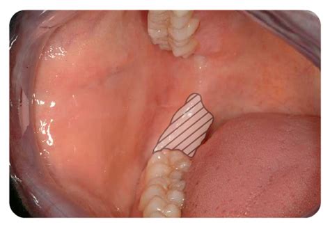 Buccal Cavity Ablation Procedure に対する画像結果
