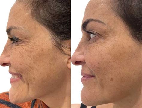 Image result for Botox Wrinkle Cream