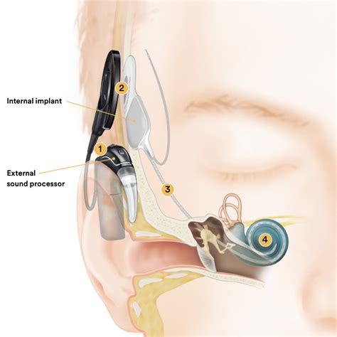 Image result for BSL How Cochlear Implants Work