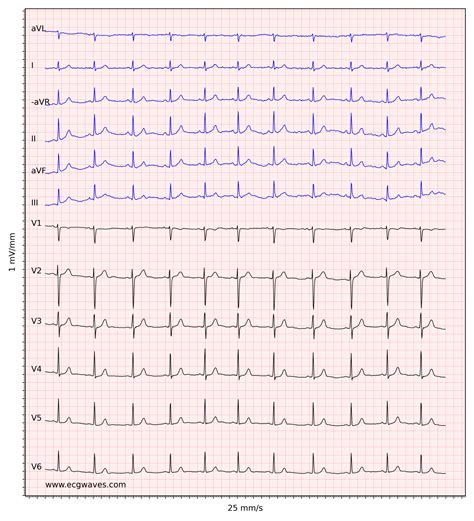 Image result for Normal EKG Measurement
