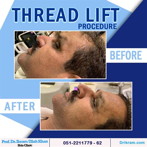 Image result for Thread Lifting Procedure