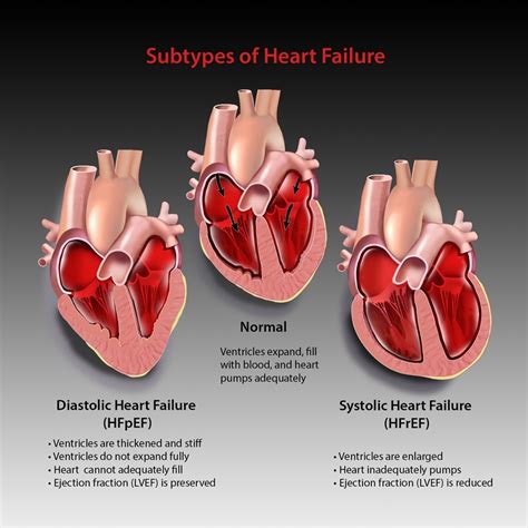 Subtypes of Heart Failure Illustration by Jackie Heda | Medical ...