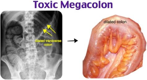 Toxic Megacolon Next to Normal に対する画像結果