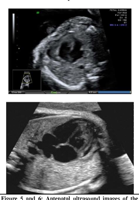 Toradh íomhá ar Atrial Septal Defect Classification