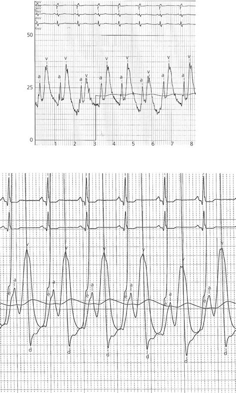 Toradh íomhá ar Normal Capnography Waveform
