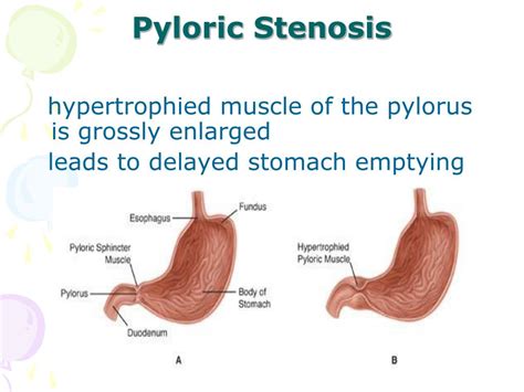 Image result for Intussusception Diagnostic Test
