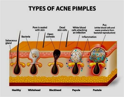 Image result for Acne/Pimples