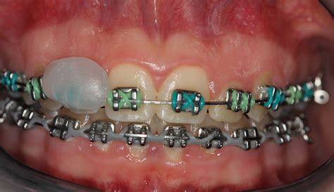 Image result for Ortho Spots Brackets