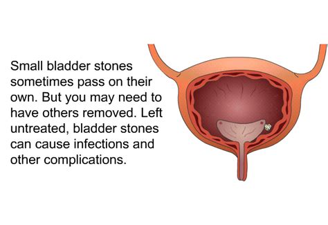 PatEdu.com : Continuous Bladder Irrigation