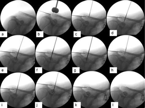 Toradh íomhá ar Endobutton Acromioclavicular Joint