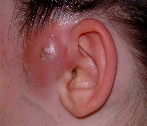 Carbuncle Symptoms に対する画像結果