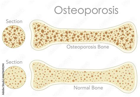 Image result for Porous Bone Structure