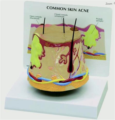 Image result for Acne Model