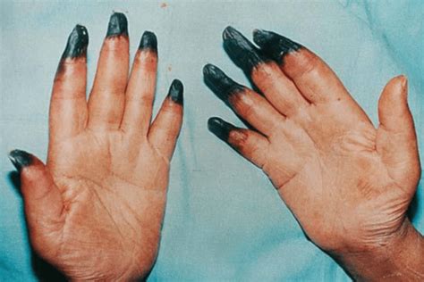 Image result for Apls Work Up