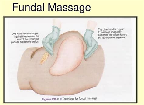 Image result for How to Give Fundal Massage Step by Step