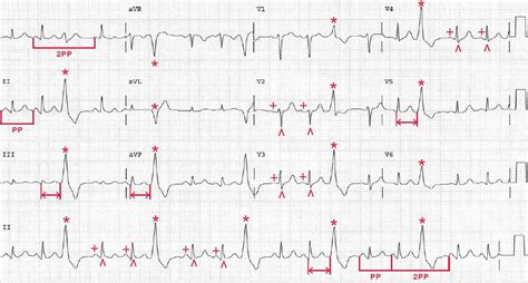 Image result for Sinus Rhythm with Pac and PVC
