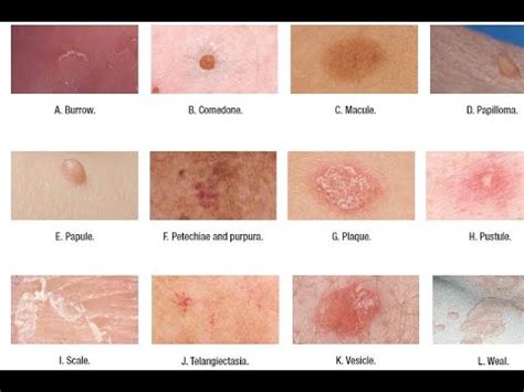 Toradh íomhá ar Sizes of Cutaneous Defect