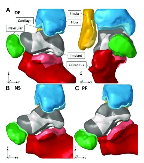 Image result for PF Joint-Replacement