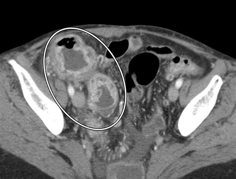 Image result for CT Enterography