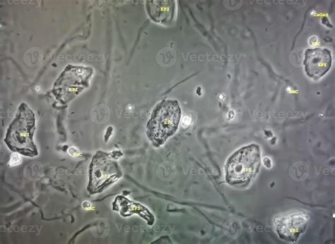 Toradh íomhá ar Microscopic Exam On Urine