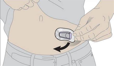 How to Apply a Dexcom Sensor Step by Step に対する画像結果