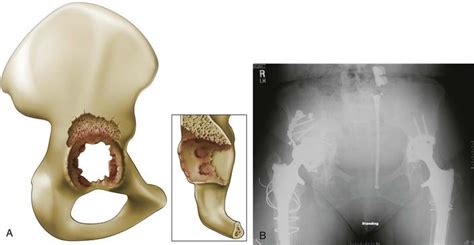 Afbeeldingsresultaten voor AAOS Acetabular Defect Classification