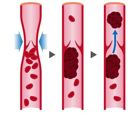 Image result for SCD DVT Prophylaxis
