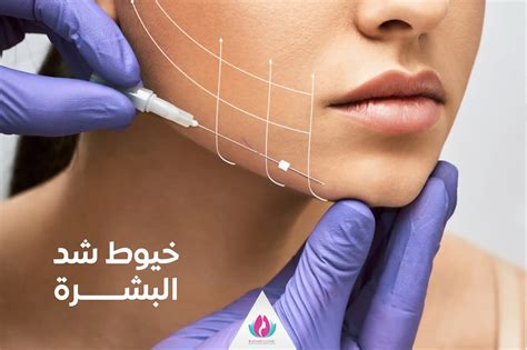 Image result for Thread Lifting Procedure