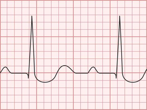Image result for Digoxin Pulse Waveform