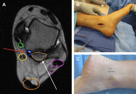 Ankle Posterolateral Approach に対する画像結果