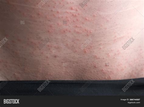 Rash On Skin Man Groin Image & Photo (Free Trial) | Bigstock