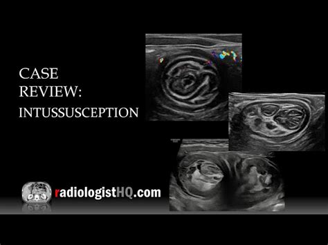 Image result for Intussception in Ultrasound