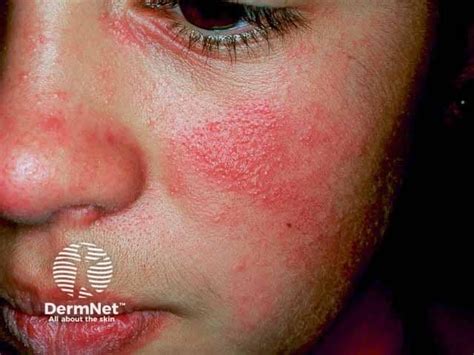 Rhus Dermatitis Face-এর ছবি ফলাফল