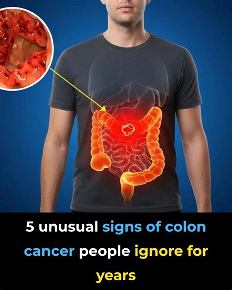 Image result for Subtle Signs of Colon Cancer