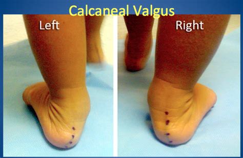 Image result for Pes Planovalgus