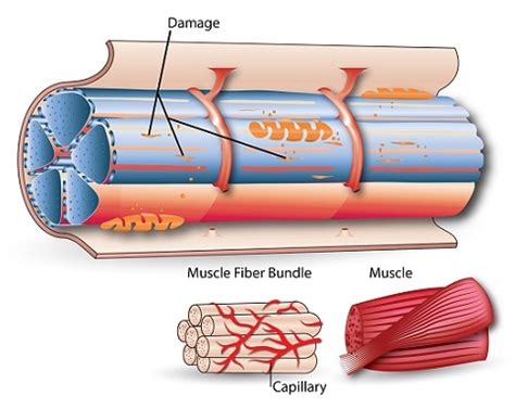 Delayed Muscle Onset に対する画像結果